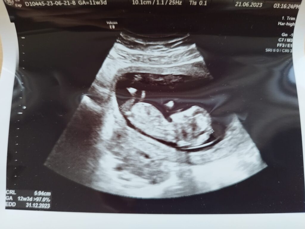 hamilelik 11 hafta ultrason görüntüsü