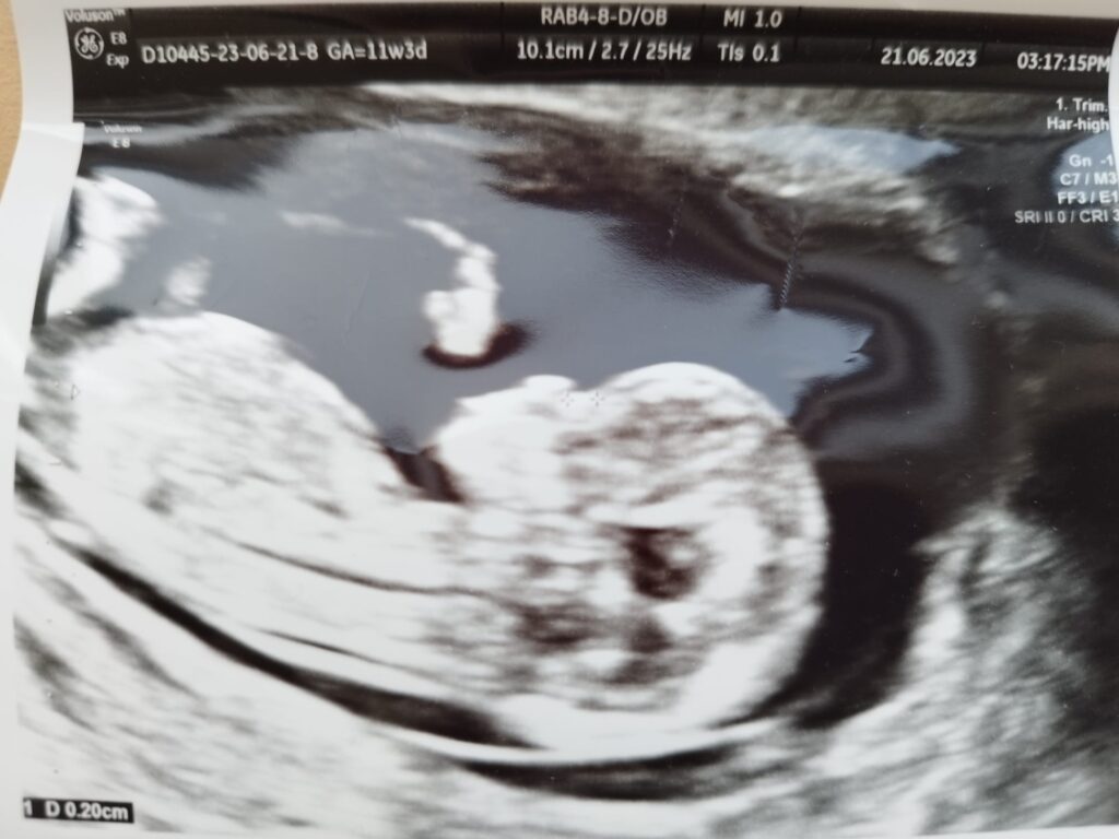 hamilelik 11 hafta ultrason görüntüsü