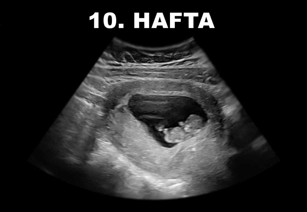10. hafta ultrason görüntüsü